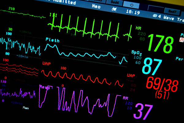 ekg monitor